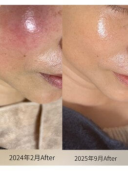 サロン ド エン(Salon de. en)/長年の赤み◇ハーブピーリング