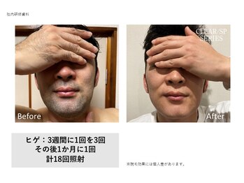 ロミオワックス ジュリエットワックス 新宿店(ROMEO Wax Juliet Wax)/髭脱毛/光脱毛ビフォーアフター