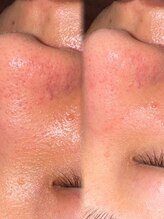 アクシア ビューティー サロン(AXSIA)/【毛穴洗浄＋モデリングパック】