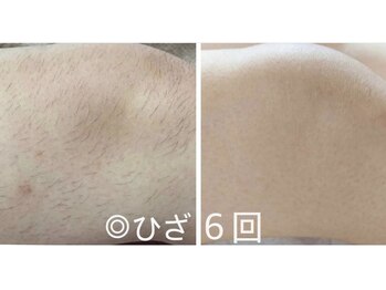 アイビークイーン(I.B.QUEEN)/チクチクお肌がつるっつるに