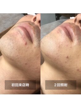 リムル(REMURU)/ひげ脱毛2回照射