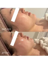 ルシェリア(Le cherien)/艶肌と小顔効果