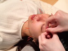 パレット(PALETTE)/【施術風景】美容鍼/小顔矯正