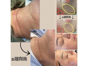 リュミエール デスポワール(Lumiere d'espoir)/原液100%臍帯幹細胞