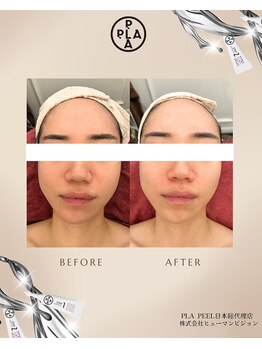 ココ センガ ビューティー クリニック(COCO SENGA Beauty-Clinic)/韓国肌管理プラピール効果写真