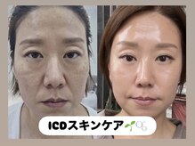 ラヴィ(Ravi)/ICDスキンケア