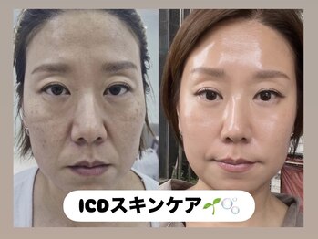 ラヴィ(Ravi)/ICDスキンケア