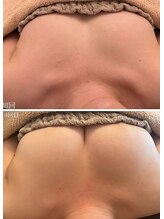 美人バスト 岡崎店/【バストアップ★育乳】症例