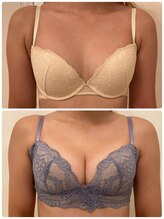 美人バスト 豊橋店/バストアップ症例【バストケア】