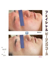 アイリス(AIRIS)/フェイシャル/毛穴洗浄/美白