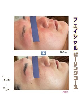 アイリス(AIRIS)/フェイシャル/毛穴洗浄/美白