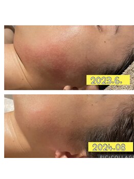 インチャント(enchant)/敏感肌と赤みケアの難しさ