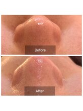 コンジュ(kongju)/韓国式3D毛穴洗浄