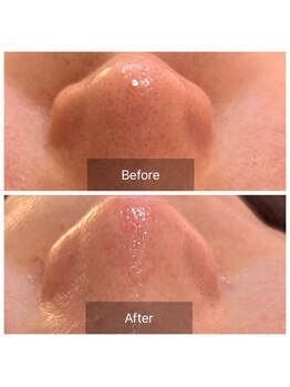 コンジュ(kongju)/韓国式3D毛穴洗浄