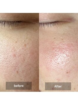 ルミエール(Lumiere)/ハリ感UP毛穴ケアに♪