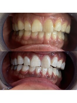 エクシアホワイトニング 新小岩店/ホワイトニングビフォーアフター