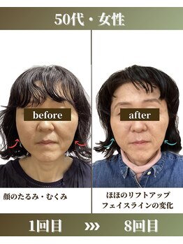 けいのき鍼灸整骨院/美容鍼3ヵ月8回の効果！美容鍼灸