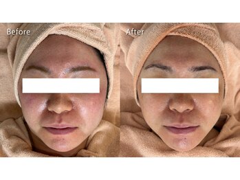 ミュー 春日井店(mieux)/◆肌質改善例