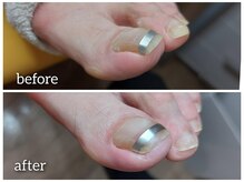 爪切り屋 足楽/【巻き爪】生え際からリフト