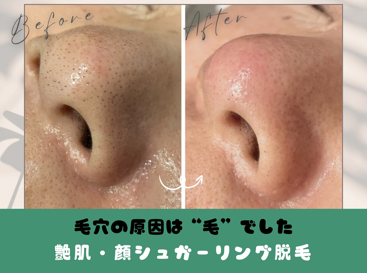 Millieです‼専用です‼　２本　脱毛❤今だけ価格8999→7999 Millieです‼専用です‼ 2本 脱毛❤今だけ価格8999→7999