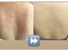 オーシャンブルー 長崎店(OCEAN BLUE)/背中ダイヤモンドピーリング症例