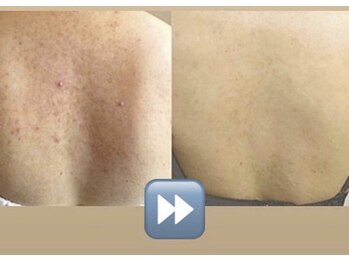 オーシャンブルー 長崎店(OCEAN BLUE)/背中ダイヤモンドピーリング症例