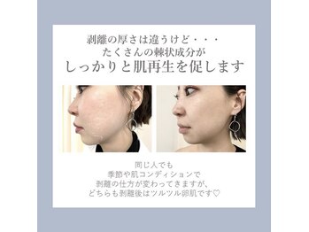 ハーバリー ハーブピーリング 岐阜(HERBERRYハーブピーリング)/ハーブピーリング専門店HERBERRY