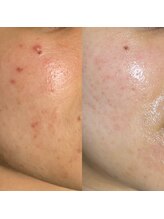 ベル(Belle)/マイクロニードルピーリング