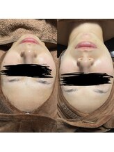 ミナアズアシリ(MINA as asir)/水素パック症例写真