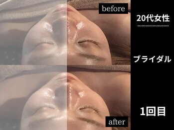 ミーツ(MEETS)/右側の施術前と施術後