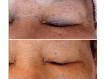 エム(M)/ハーブピーリング