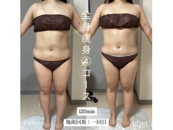 エヌボーテ(N. beaute)/全身痩身4回コース#4回目