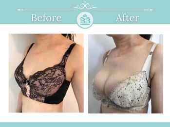 美人バスト 南森町店/バストアップ◇症例◇