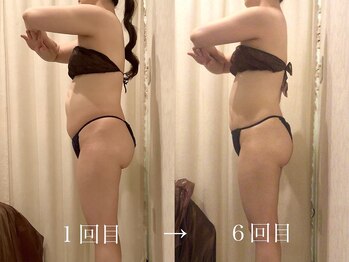 上野エステサロン レア(Lea)/痩身／エステ