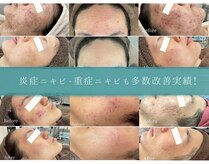 ニキビケア研究所 北千住店