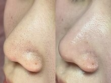 エミュ(emu)/聞いなる毛穴詰まりには毛穴ケア