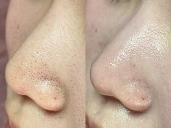 エミュ(emu)/聞いなる毛穴詰まりには毛穴ケア