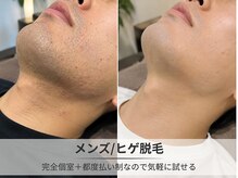 フルーブラン(Frubran)/はじめてのヒゲ脱毛体験