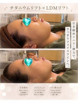 エスポワの写真/40代からのほうれい線・たるみ予防に！人気No.1【チタニウムリフト×LDMリフト/19800円】で集中ケア！