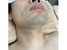 ナノハナ/鹿沼市の全身脱毛のナノハナ