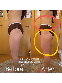 エステティックサロン やまとなでしこ/美容溶解☆閻魔トリートメント