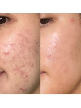 イエナ(IENA)/大人ニキビもお任せ下さい!