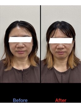 ラムーン(La.Moon)/小顔・美容鍼4回