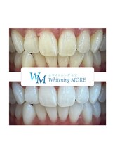 ホワイトニング モア(Whitening MORE)/ビフォーアフター