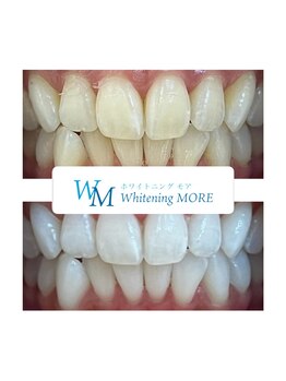ホワイトニング モア(Whitening MORE)/ビフォーアフター