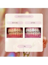 プラスビーセルフ(+b self)/ホワイトニングビフォーアフター