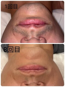 完全都度払い 明石メンズ脱毛/before/after 髭8回目