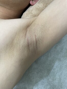 ナノハナ/鹿沼市の全身脱毛のナノハナ