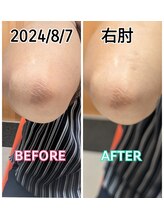 コカゲ(Kokage)/ひじパック