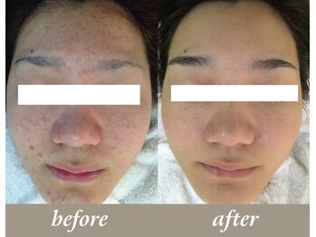 ベルミーランド 田原本/お肌あれ改善も得意☆